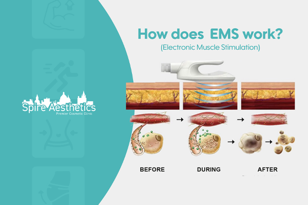 EMS treatment for post pregnancy weight loss treatment Bridge End