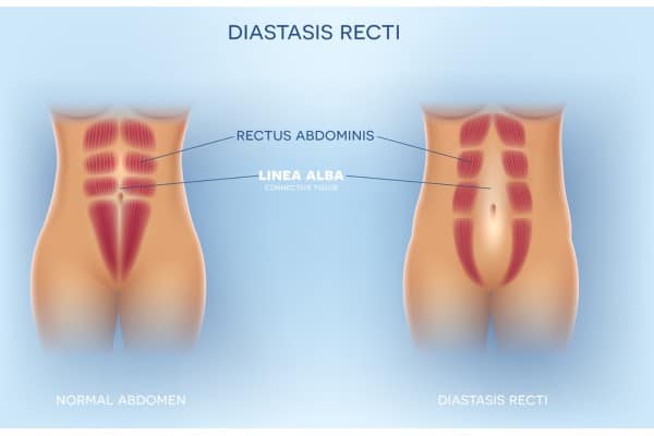 What Non-Surgical Options Are Available for Diastasis Recti Bridge End?