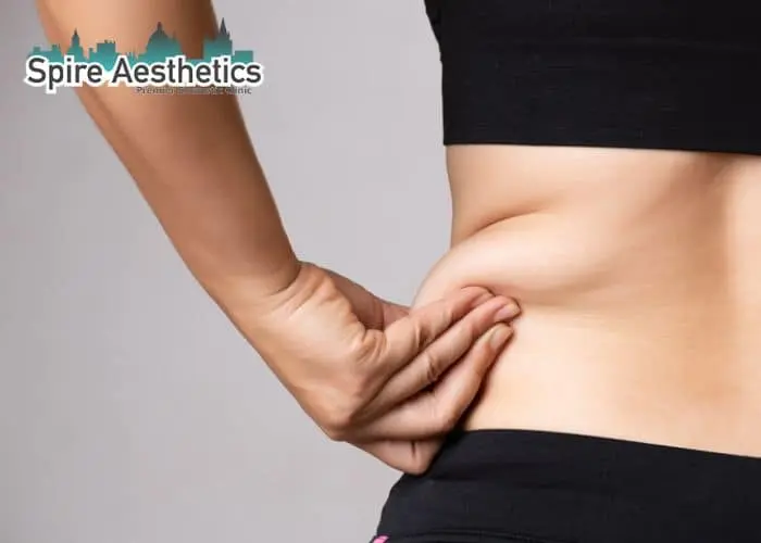 Image of woman pinching fat on their hips Bridge End. Fat Freezing treatment