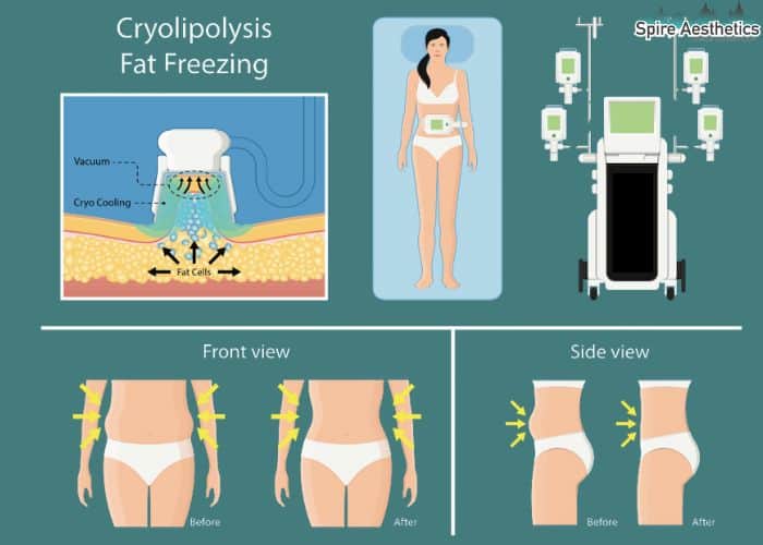 Image of diet and fat freezing combined for best results for Spire Aesthetics Bridge End