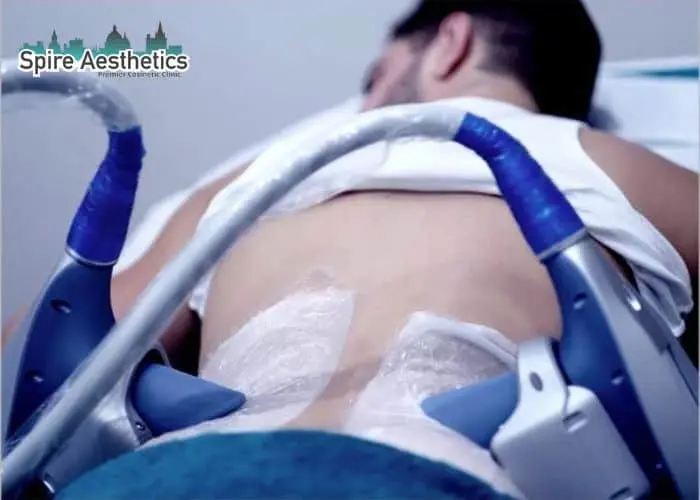 Man having fat freezing treatment done on love handles before a competitions Bridge End to create a sculpted look.
