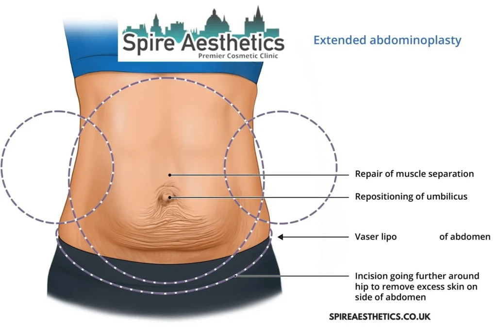 Understanding Loose Skin After Gastric Band Bridge End Surgery and HIFU Treatment