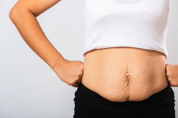 Image of a woman's stomach after weight loss with sagging skin following a gastric band Bridge End