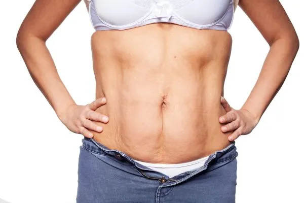 sagging skin on woman's stomach after weight loss injections Bridge End